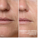 Ампули з гіалуроновою кислотою Babor Hyaluronic Acid Ампули з гіалуроновою кислотою Babor Hyaluronic Acid