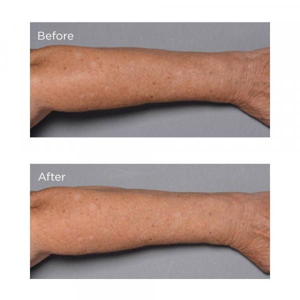 Відновлювальний крем для тіла Perricone MD Cold Plasma Plus+Fragile Skin Therapy